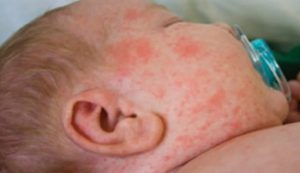 علائم سرخک در نوزادان و کودکان